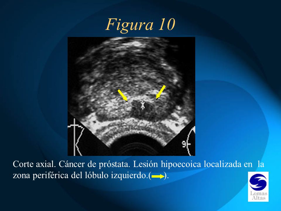 area hipoecoica prostata